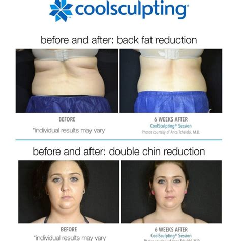 cool sculpting northbridge|CoolSculpting .